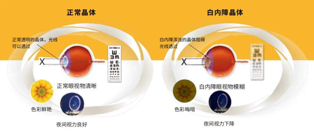 玻璃體混濁最新特效藥，突破與創(chuàng)新的治療策略